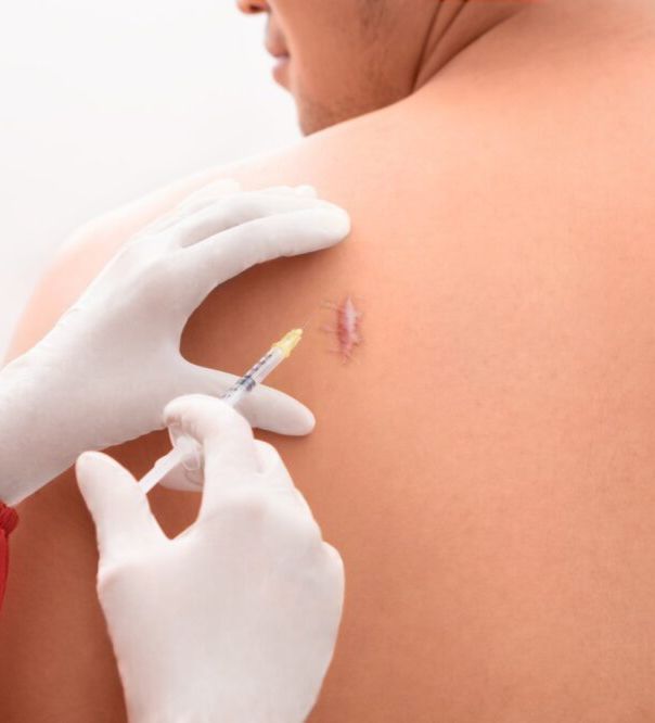 Injeksi Keloid