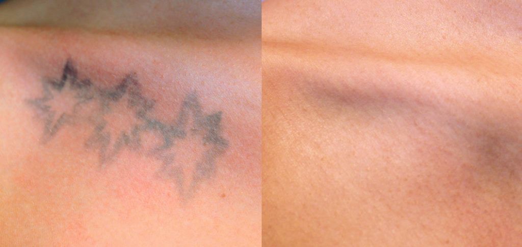 Laser Picosecond Remove Tatto 5 x 15 m