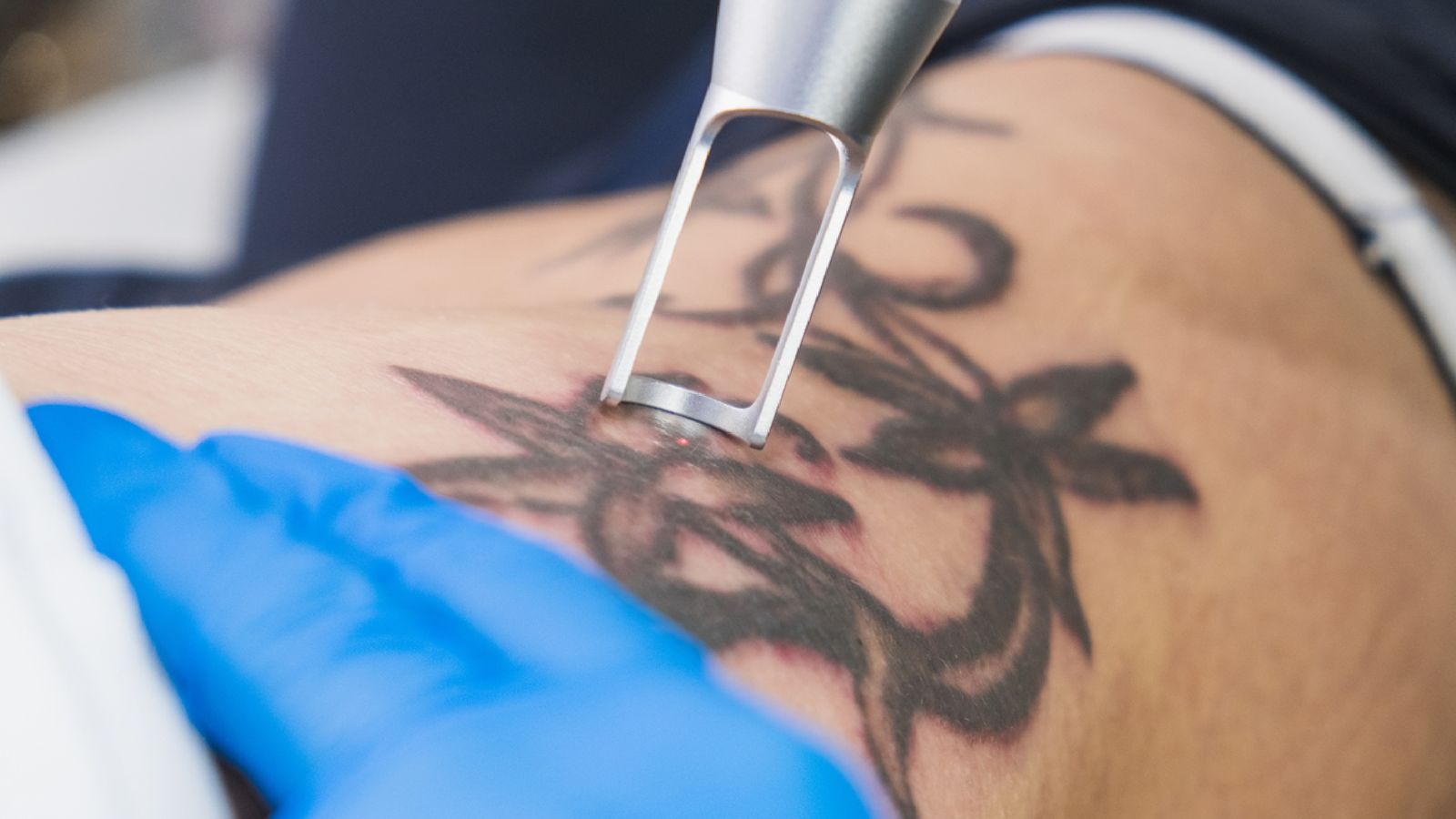 Laser Picosure Remove Tatto 5 x 10 m